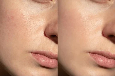 dermaplane razor benefits & risks